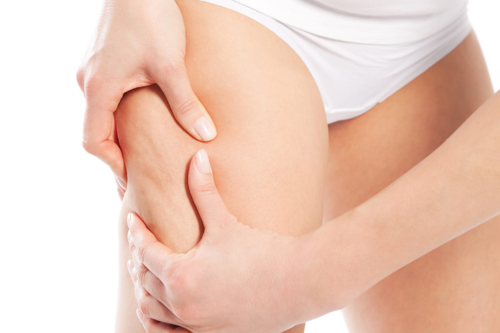 cellulite-krper-und-schnheit-2